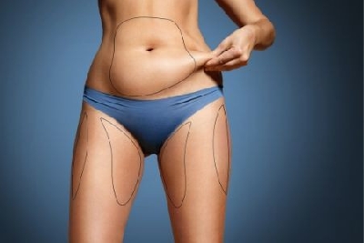trattamento liposuzione
