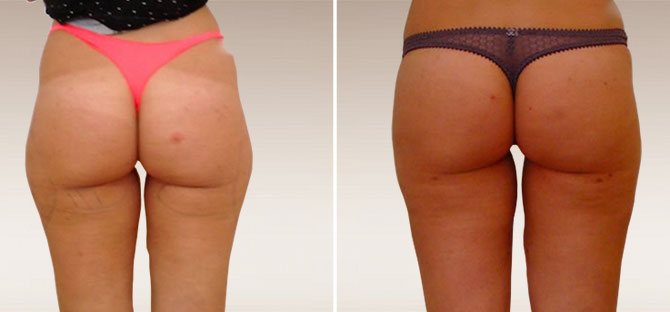 Foto Liposcultura