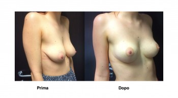 Foto mastopessi per sollevare il seno