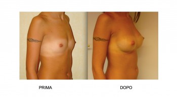 Foto mastoplastica additiva per l'aumento del seno