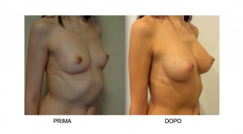 Foto mastoplastica additiva per l'aumento del seno