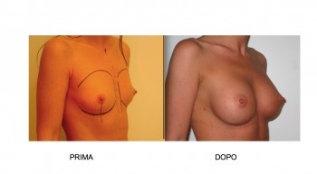 Foto mastoplastica additiva - protesi al seno
