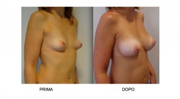 Foto mastoplastica additiva protesi mammarie anatomiche