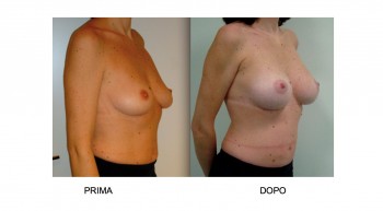Mastoplastica Additiva intervento di chirurgia plastica al seno